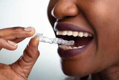 patient putting her new clear aligners in her mouth